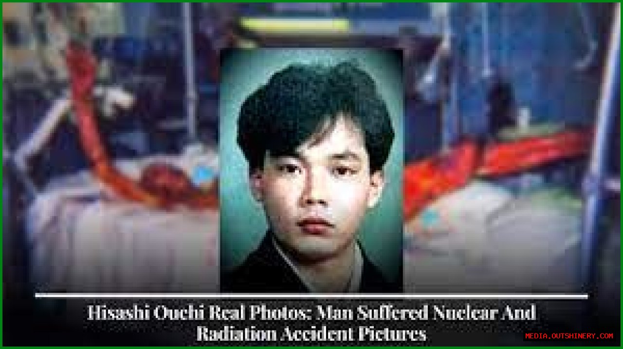 Hisashi Ouchi: The True Story Behind The Real Photos And Tragic Incident