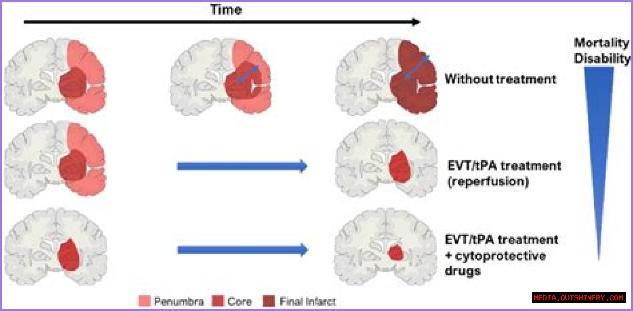 Understanding Peter Griffin Stroke: A Comprehensive Analysis