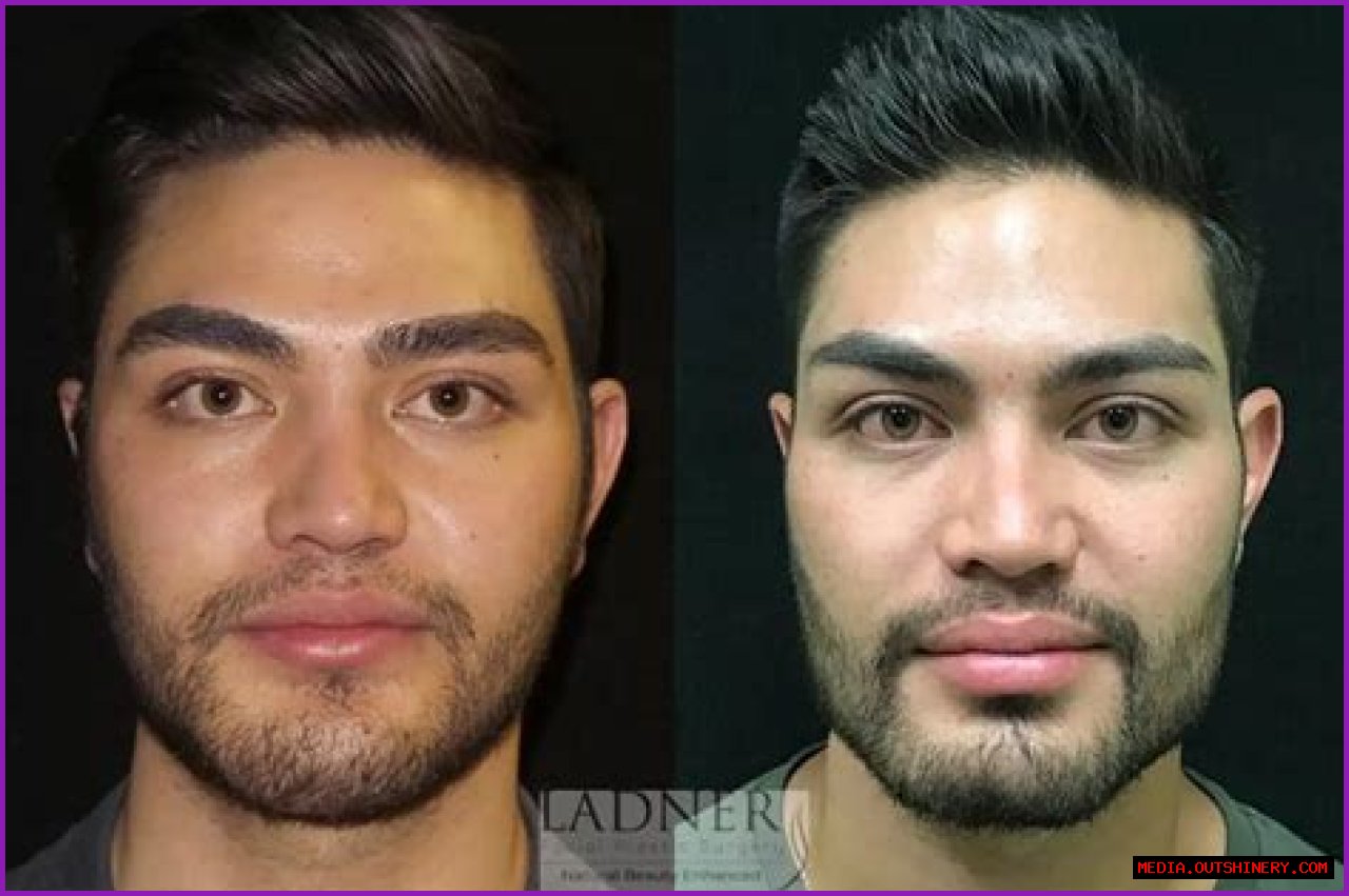 Unveiling The Transformation: Sophie Turner And Buccal Fat Removal